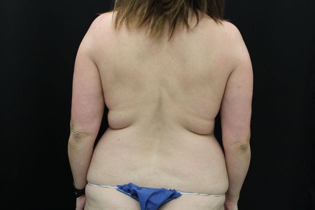 Liposuction: Case 10 - Before
