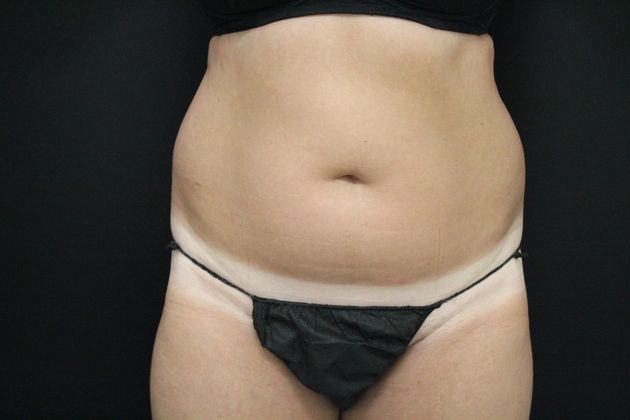 Liposuction Case 11 - Before