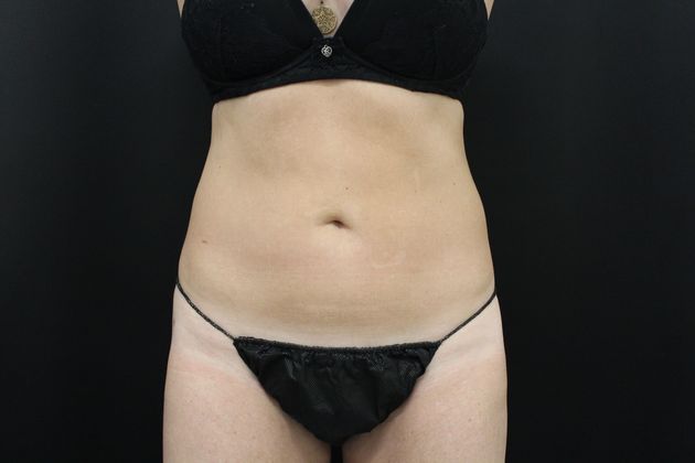 Liposuction Case 11 - After