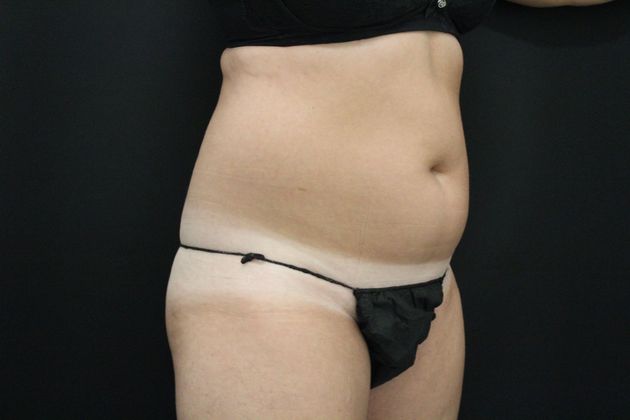 Liposuction: Case 11 - Before