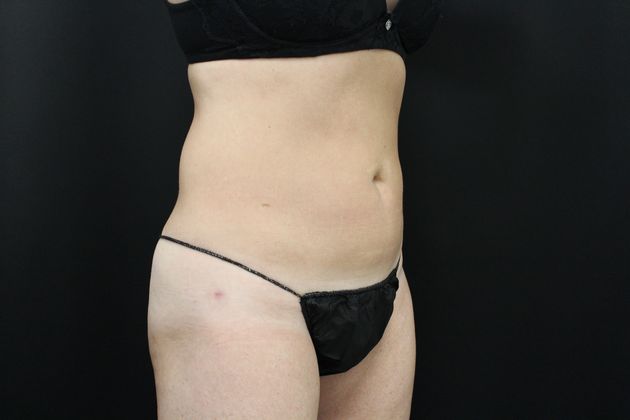 Liposuction: Case 11 - After