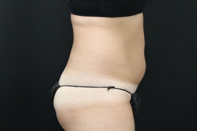 Liposuction: Case 11 - Before