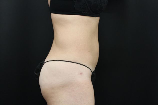 Liposuction: Case 11 - After