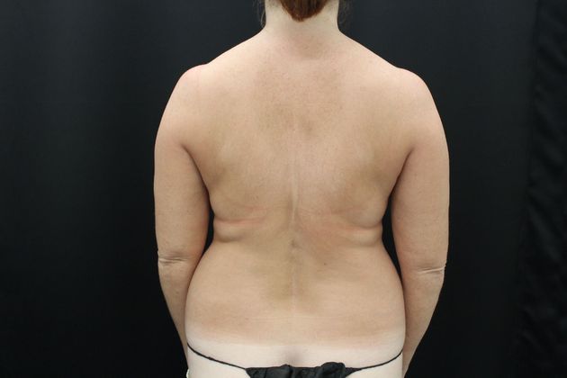 Liposuction: Case 11 - Before