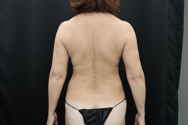 Liposuction: Case 11 - After