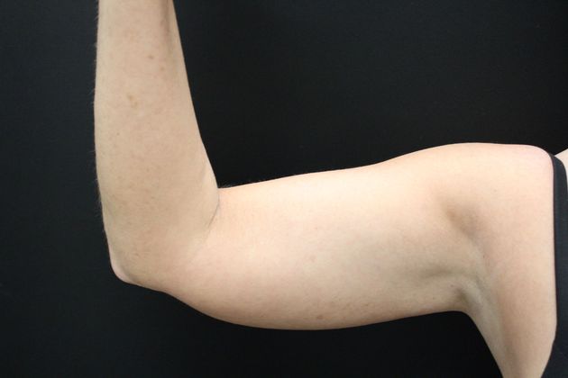 Liposuction Case 12 - Before