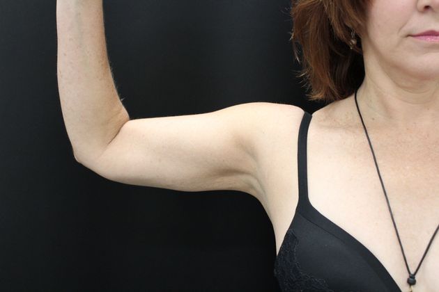 Liposuction Case 12 - After