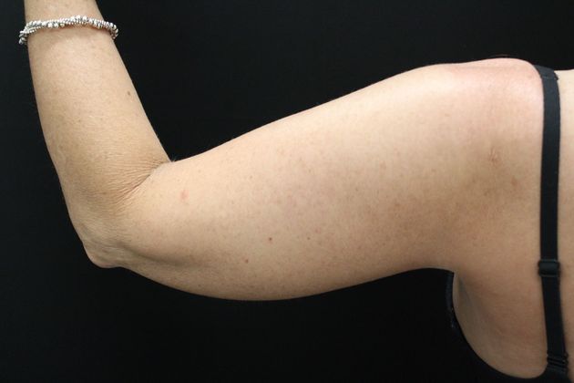 Liposuction: Case 12 - Before