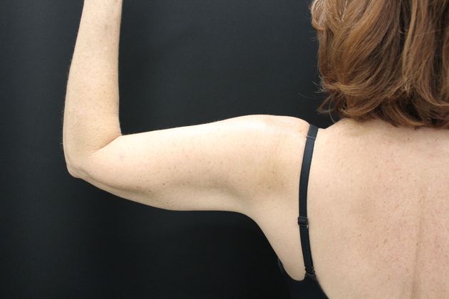 Liposuction: Case 12 - After