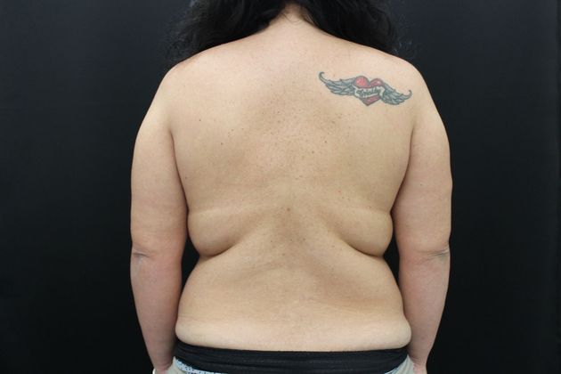 Liposuction Case 14 - Before