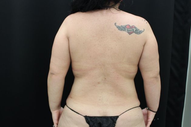 Liposuction Case 14 - After