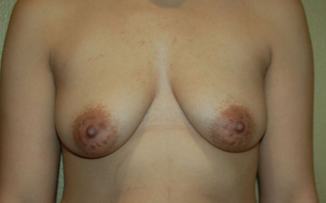 Breast Augmentation w/ Lift: Case 231 - Before