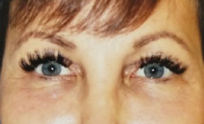 Selphyl - Platelet Rich Plasma: Case 1 - After 2nd Treatment