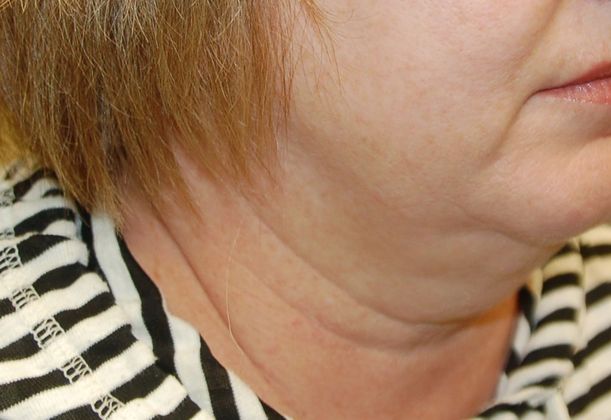 Facelift: Case 9 - Before