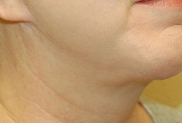 Facelift: Case 9 - After