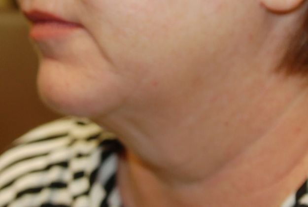 Facelift: Case 9 - Before