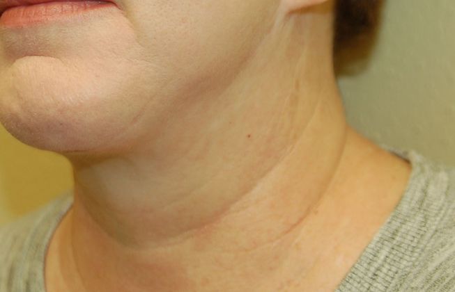 Facelift: Case 9 - After