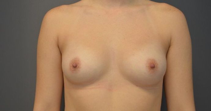 Breast Augmentation Case 9 - Before