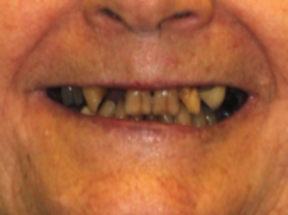 Full Mouth Rehabilitation Case 1 - Before