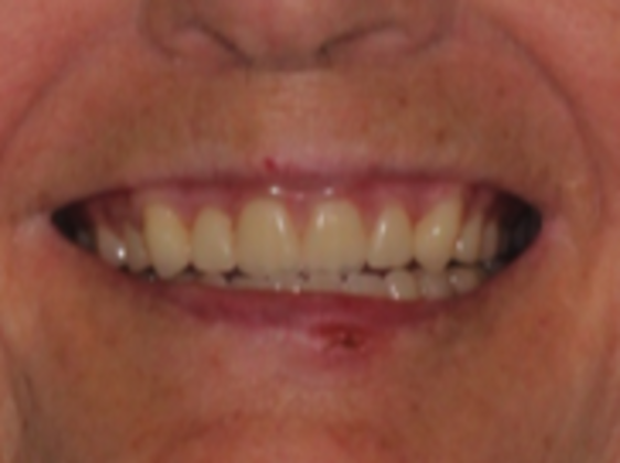 Full Mouth Rehabilitation Case 1 - After