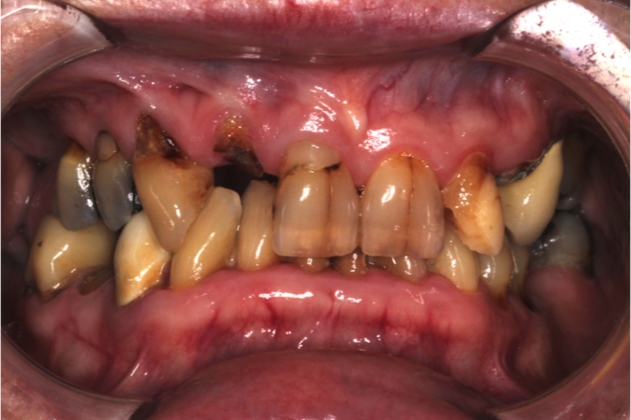 Full Mouth Rehabilitation: Case 1 - Before