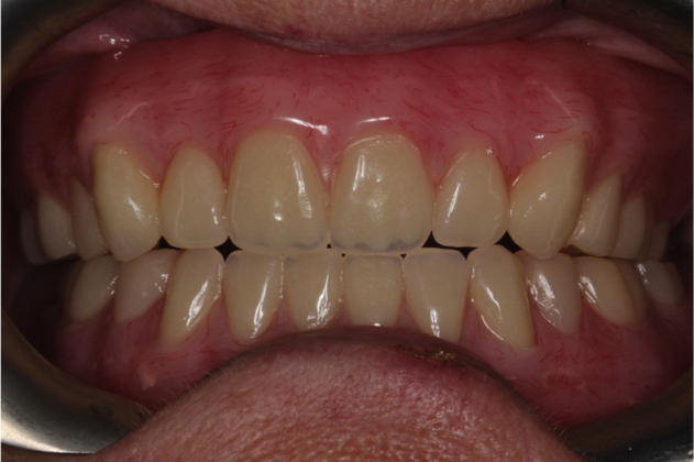 Full Mouth Rehabilitation: Case 1 - After