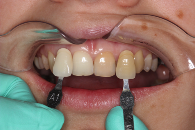 Teeth Whitening Case 1 - Arvada, CO - Before