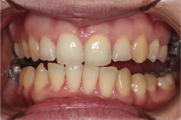 Teeth Whitening Case 1 - Arvada, CO - After