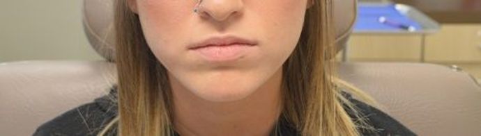 Cosmetic Injectables & Fillers: Case 1 - Before