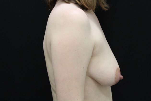 Breast Lift/Breast Lift Augmentation: Case 24 - before