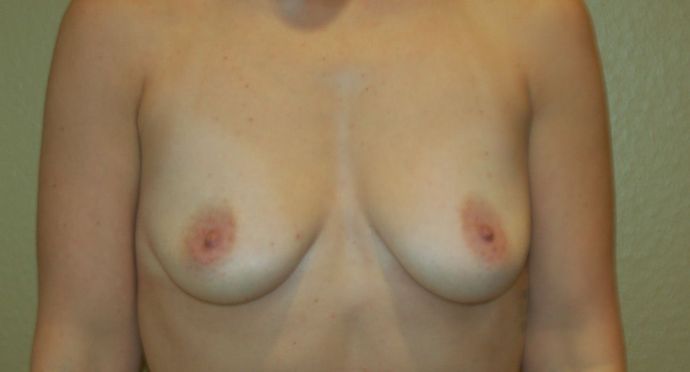 Breast Augmentation Case 4 - Before