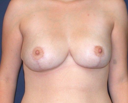 Breast Lift Case 2 - After
