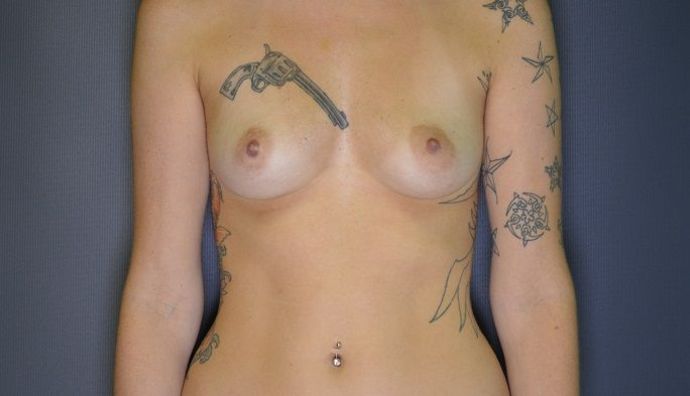 Breast Augmentation Case 10 - Before