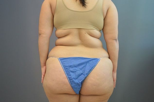 Liposuction Case 6 - Before