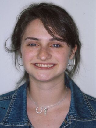 Full Mouth Reconstruction Case 4 - Before