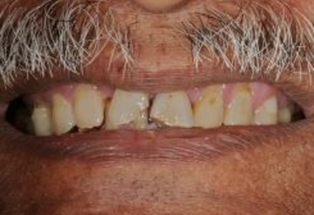 Porcelain Crowns: Case 1 - Before