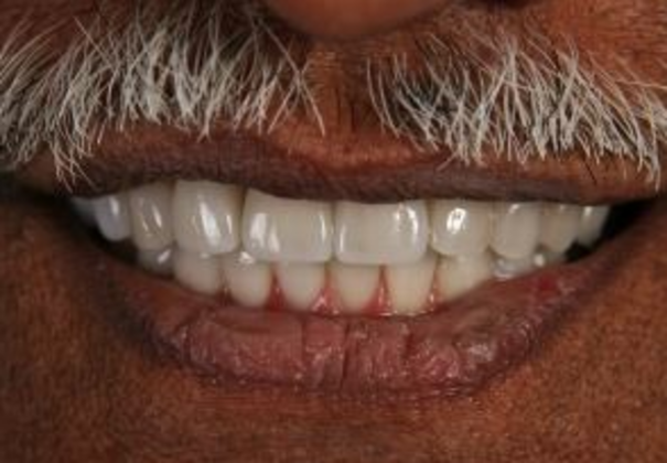 Porcelain Crowns: Case 1 - After