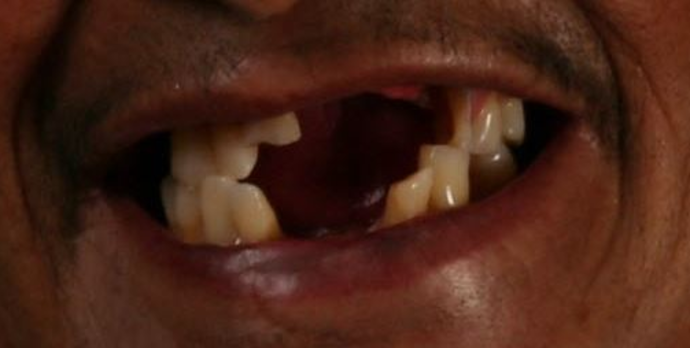 Dentures: Case 2 - Before