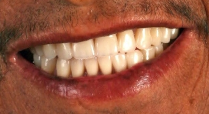 Dentures: Case 2 - After