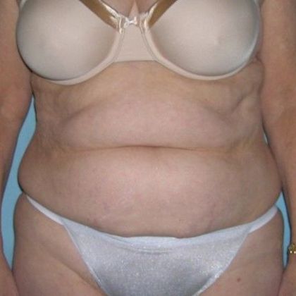 Tummy Tuck: Case 5 - Tummy Tuck, Stamford - Before