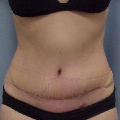 Abdominoplasty Patient Photo - Fairfield, CT Plastic Surgeon - Tummy Tuck -  Before and After Gallery