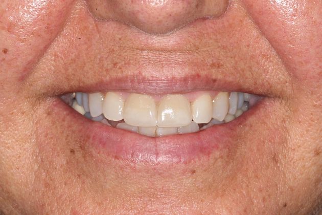 Cosmetic Dentistry: Case 1 - Porcelain Crowns Arvada, CO - After