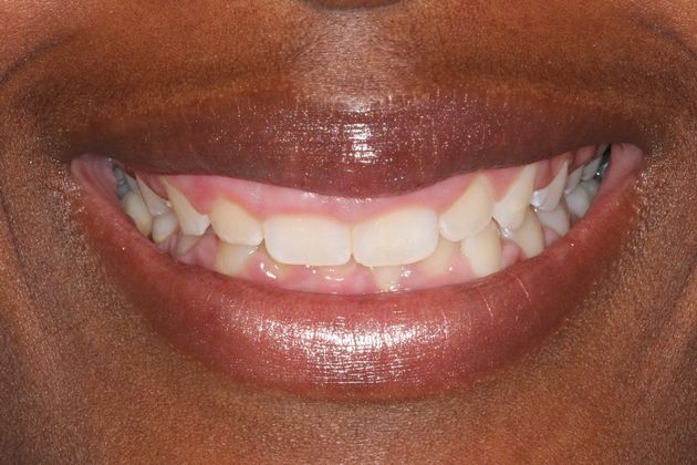 Smile Makeover: Case 1 - Gummy Smile in Arvada, CO - Smile Before