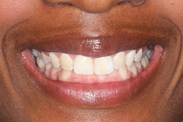Smile Makeover: Case 1 - Gummy Smile in Arvada, CO - Smile After