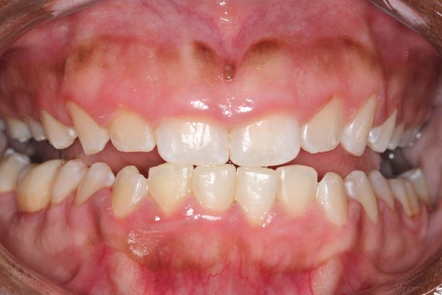 Smile Makeover: Case 1 - Gummy Smile in Arvada, CO - Retracted Before