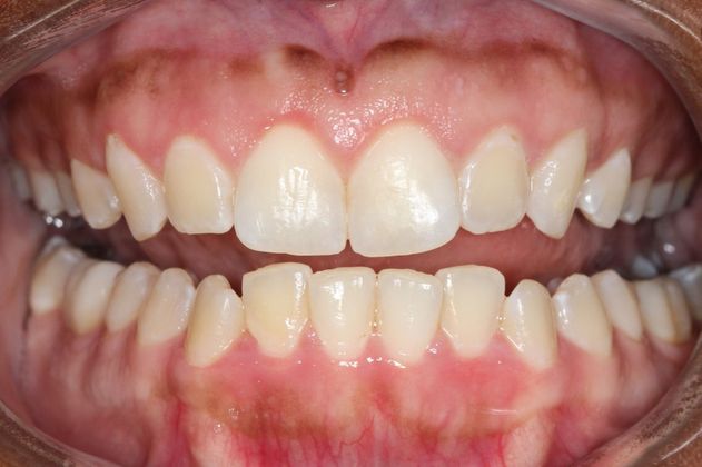 Smile Makeover: Case 1 - Gummy Smile in Arvada, CO - Retracted After