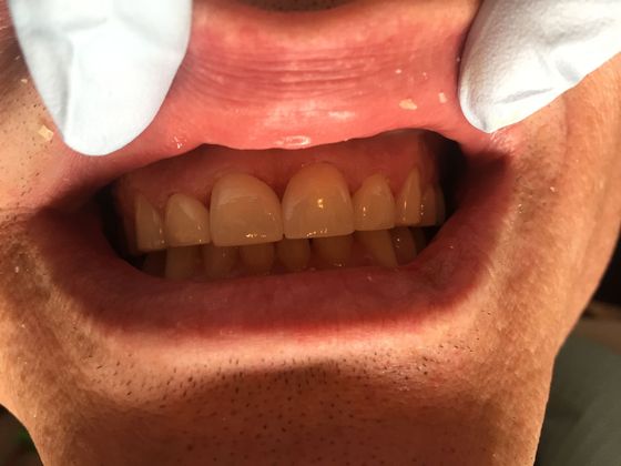 Smile Makeovers, actual cases of our dentists, no special lighting or editing: Case 7 - after