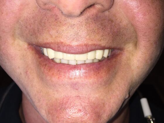 Smile Makeovers, actual cases of our dentists, no special lighting or editing: Case 8 - after