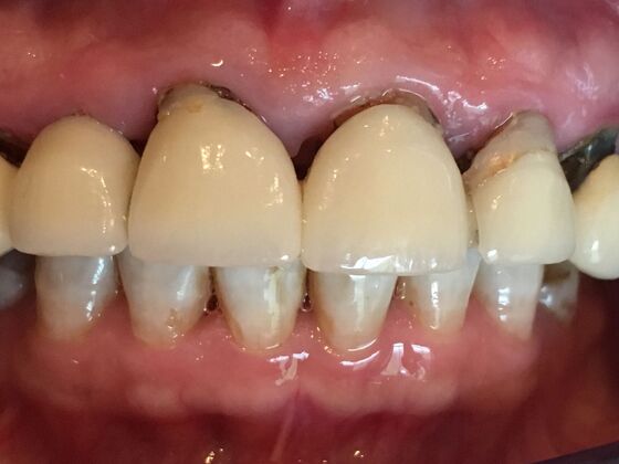 Smile Makeovers, actual cases of our dentists, no special lighting or editing Case 9 - Before