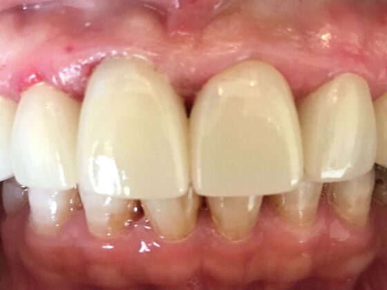 Smile Makeovers, actual cases of our dentists, no special lighting or editing Case 9 - After